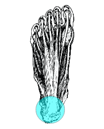 plantart fasciitis