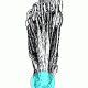 Plantar Fasciitis