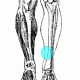 Shin Splints