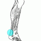 Achilles Tendonitis