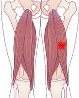 Recurrent Hamstring injuries