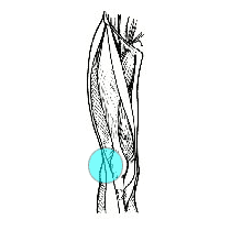 illitibiol band syndrome