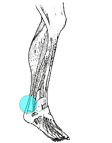 Hälseneinflammation (Achilles tendonitis)