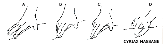 Cyriax - Deep Traverse Friction Massage